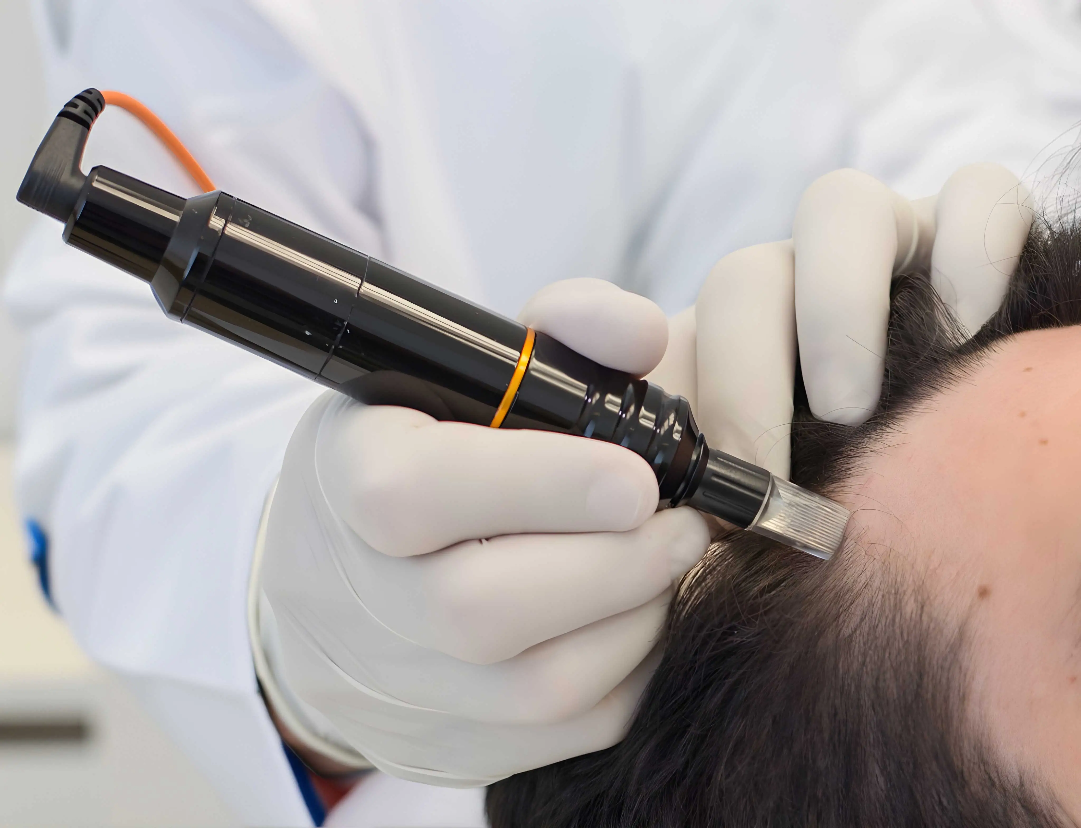 Procedimento de microagulhamento no couro cabeludo